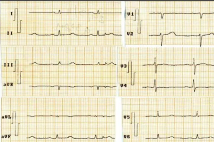 Fig 4. ECG a las 36 horas del inicio de los síntomas.