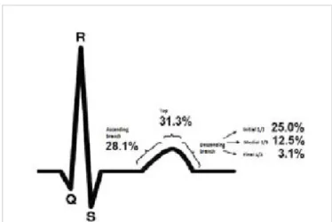 Figure 3. Site of premature ventricular contraction in the T 