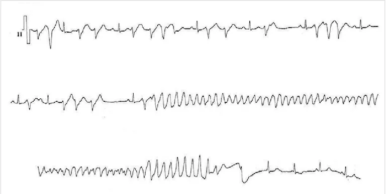 Figure 4. Patient without demonstrable structural heart disease by conventional methods, normal basal electrocardiogram, 