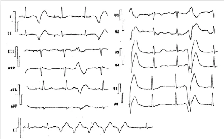 Figure 5. Patient with ancient myocardial infarction, resuscitated from episode of sudden death (from ventricular 