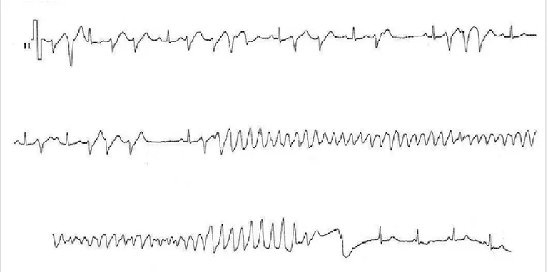 Figura 4. Paciente sin cardiopatía estructural demostrable por métodos convencionales, electrocardiograma basal normal, 