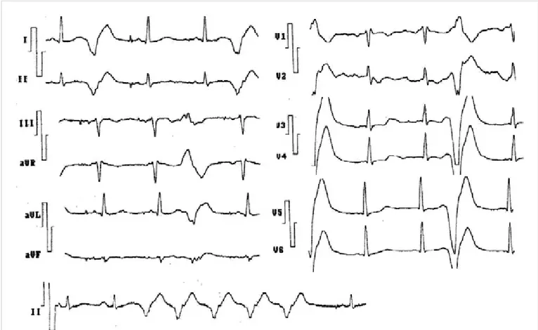 Figura 5. Paciente con infarto antiguo del miocardio, reanimado de episodio de muerte súbita (por fibrilación ventricular)