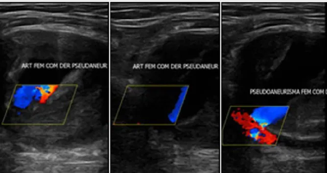 Figura 1. Imágenes de ecografía Doppler que muestran el pseudoaneurisma de la arteria femoral común derecha