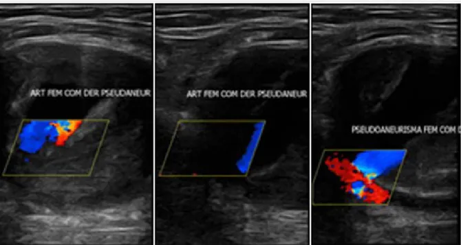 Figure 1. Doppler ultrasound images showing the femoral artery pseudoaneurysm. of the three layers of a vessel and is contained by 