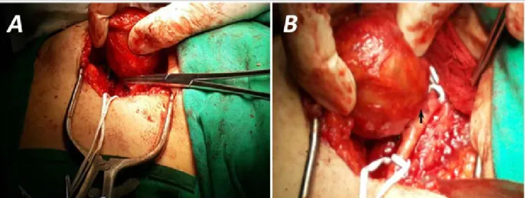 Figure 3. Sonographic images, eight months after surgery. A. Anatomical integrity of the right common femoral artery  