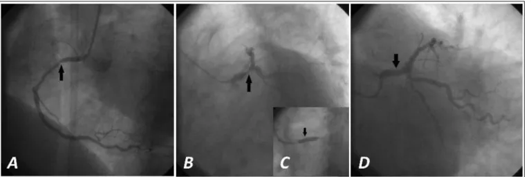 Figura 1. Coronary angiography and PTCA. A. No significant lesion in RC (arrow). Left anterior oblique view