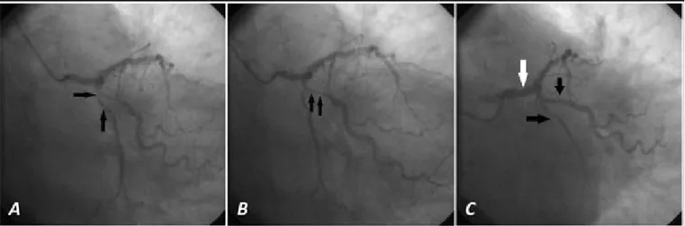 Figura 3. Angiographic control at 7 months of the second procedure. A. Persists success of all stents (arrows)
