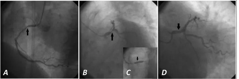 Figura 1. Coronariografía y ACTP. A. Lesión no significativa de CD (flecha). Vista oblicua anterior izquierda