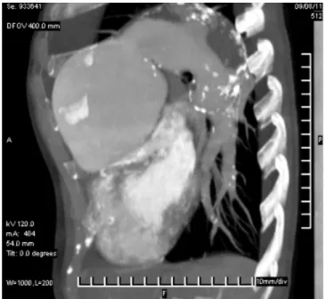 Figure 4. Tomographic angiography where the great dilation 