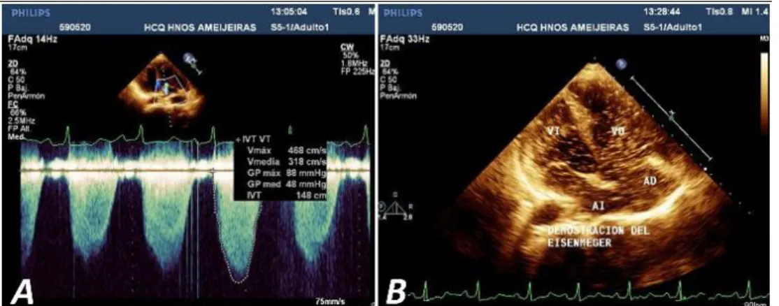 Figure 2. A. Aneurysmal dilation of PA and its branches, with the presence of thrombus in 