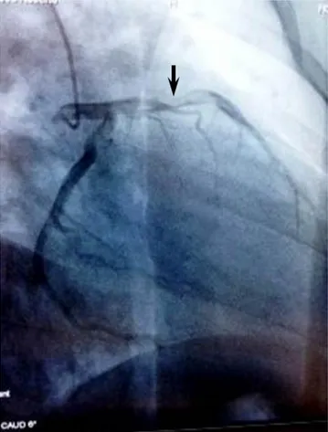 Figura 1. Cateterismo cardíaco que muestra la coronaria 