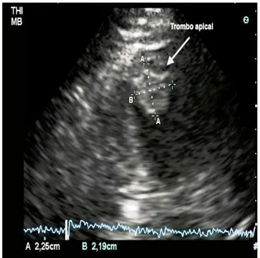 Figura 2. Imagen ecocardiográfica de trombo apical. 