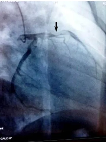 Figure 1. Cardiac catheterization showing the left 