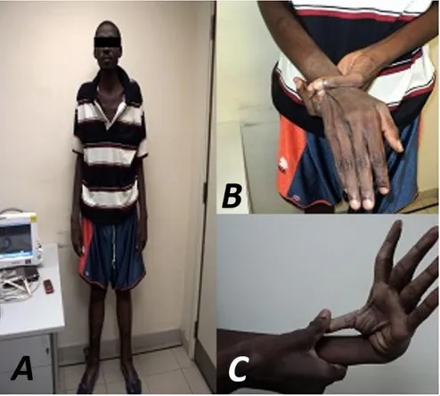 Figure 1. Skeletal characteristics of the patient. A. Above-average height,  elongated arms, decreased adipose tissue