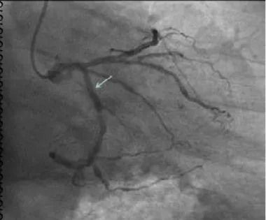 Figure 1. Coronary angiography with non-significant stenosis 
