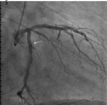 Figure  3.  Circunflex coronary arteria after stent implan-