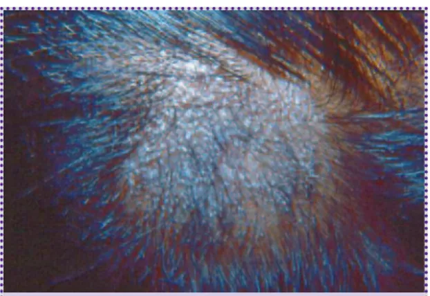 Foto 1. Tiña de la cabeza seca por Microsporum canis.