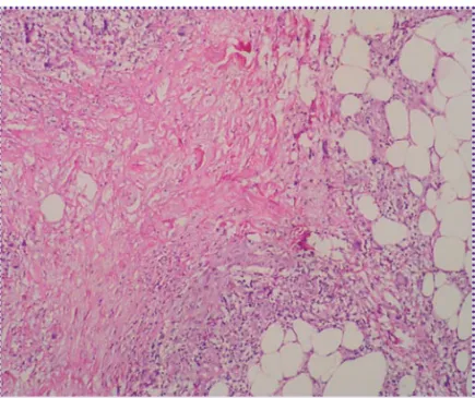 Figura 4. Detalle de paniculitis septal con infiltrado  inflamatorio de linfocitos, eosinófilos, histiocitos y  formación de células gigantes (HE 40x).
