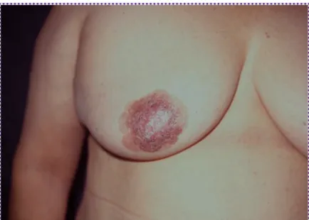 Figura 2. (H/E 20x). *Células de Paget. **Mitosis.