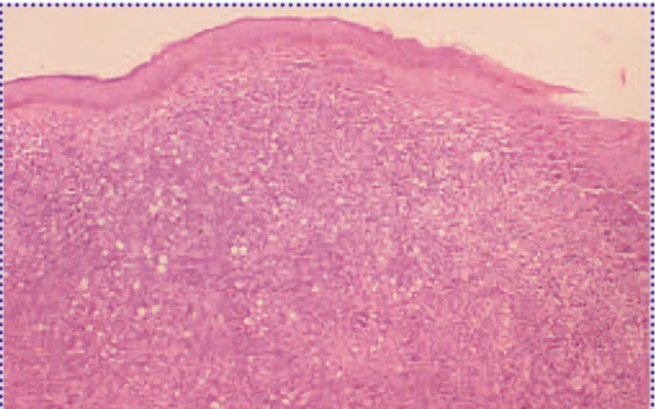 Foto 3. Histopatología, con histiocitos y amastigotes (Giemsa 100X).