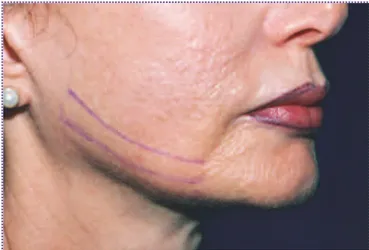Foto  6. Paciente  femenino  de  54  años  antes  de  la  colo- colo-cación de los hilos en mandíbula inferior.