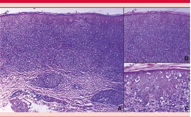 Figura 2. A.  Panorámica en la que se observa infiltrado de linfocitos neoplásicos que ocupan de manera masiva 