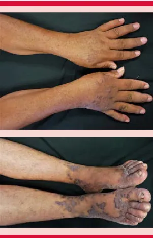 Figura 2. Lesiones tipo placas y nódulos violáceos  confluentes en las manos y los pies