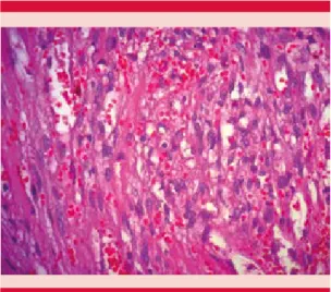 Figura 4. Detalle de corte histológico (40x). Destaca  la proliferación de células ahusadas formando  hen-diduras vasculares con eritrocitos extravasados, atipia  nuclear y abundantes mitosis.