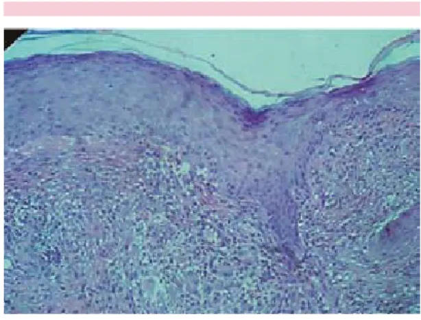 Figura 12. Granulomatosa. Acercamiento de histioci- histioci-tos y células gigantes multinucleadas tipo Langhans; el  núcleo oval, con hendidura transversal