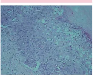 Figura 2. Patrón espongiótico con eosinófilos. Acerca- Acerca-miento del estrato de Malpighi, en el que se observan  células acantolíticas en el interior de una vesícula  in-traepidérmica acompañadas de eritrocitos y moderada  cantidad de eosinófilos