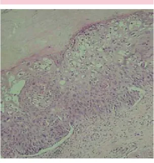 Figura 3. Panorámica. Acantosis, espongiosis de  linfocitos con edema inter e intracelular