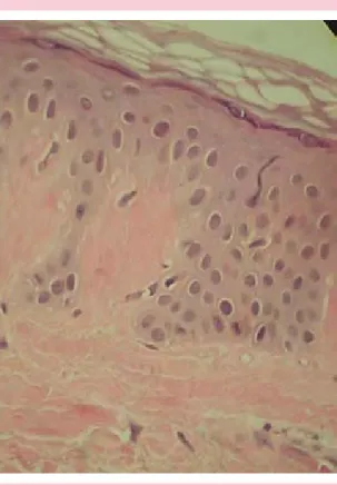 Figura 7. Biopsia de piel delgada, con esclerosis de  la dermis. H y E 10X.