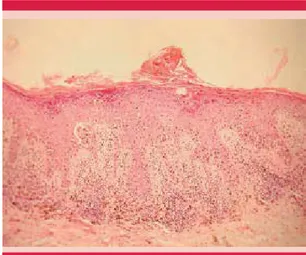 Figura 4.4PJYVMV[VNYHMxHH?JVUSH[tJUPJH/
, que muesta epidermotropismo con formación de nidos  francos y atipia celular acentuada y persistencia de  la hiper y paraqueratosis con ascenso del pigmento  de las células malignas al estrato córneo con