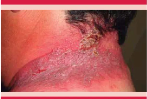 Figura 2.  Lesión cutánea localizada en la cara lateral  del cuello, con una placa eritematoviolácea de  as-pecto verrugoso.
