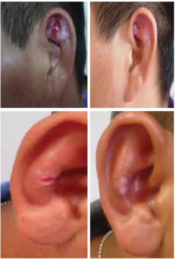 Figura 5. Pacientes con lesiones antes y después del tratamiento  con crioterapia.