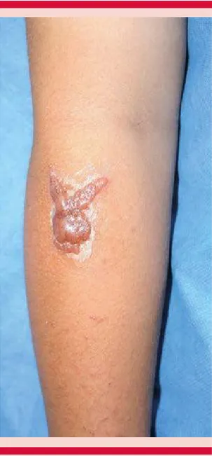 Figura 2.  Cicatriz hipertrófica asociada con tatuaje.