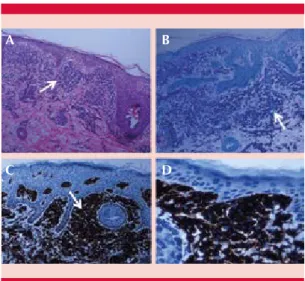 Figura 2.  Biopsia de piel.  A.  Tinción hematoxilina  eosina, dermis con papilas amplias ocupadas por  múltiples células redondeadas