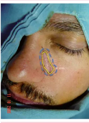 Figura 2 . Carcinoma basocelular sólido con 4 mm 