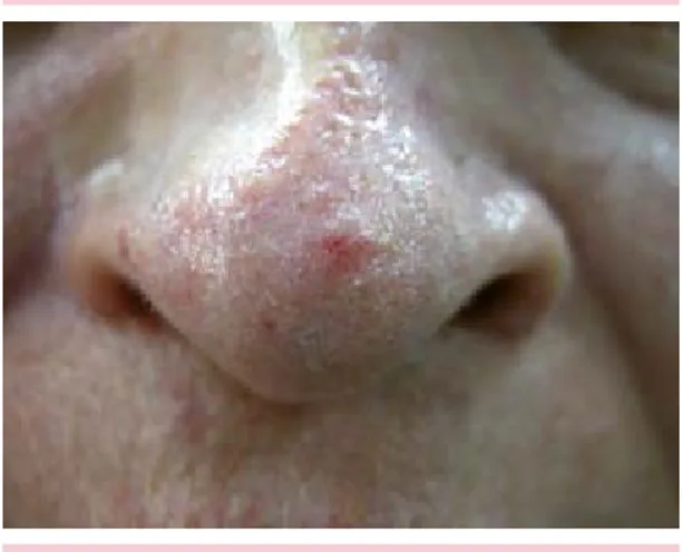 Figura 1.  Dermatosis localizada en el dorso nasal,  caracterizada por una placa anular mal definida de  color rosado y de aproximadamente 5 mm de  diáme-tro, centro deprimido, bordes levemente elevados y  evolución de 10 años.