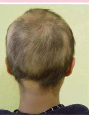 Figura 2.  Alopecia areata multifocal. Múltiples placas  alopécicas diseminadas en la piel cabelluda, algunas  tienden a confluir.