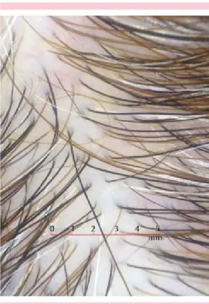 Figura 1. Alopecia difusa con predominio en la línea  media. Cortesía de la Dra. Miteva.