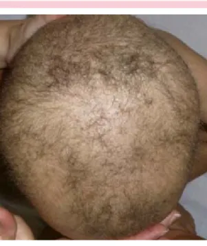 Figura 1.  Cabello frágil, delgado, seco, escaso y que- que-bradizo. Este aspecto del cabello se denomina cabello  tricotiodistrófico