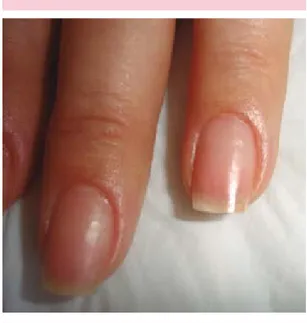 Figura 5.  Uñas de las manos con remisión completa  de xantoniquia tras 10 meses de tratamiento.