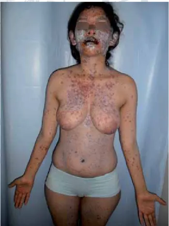 Figura 1.  Aspecto general de la dermatosis.