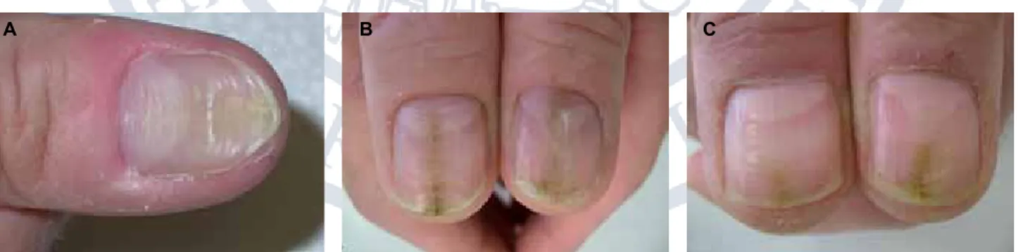 Figure 2. A. Habit tic of maniacally pushing back the proximal nail fold led to a wash-board like deformity in the central nail portion