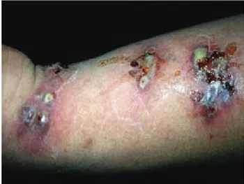 Figura 5. Infección bacteriana agregada.