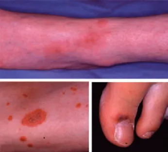 Cuadro 4. Presentación clínica en pacientes con vasculitis cutánea 