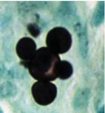 Figura 3. Levaduras multigemantes de Paracoccidioides brasilien-