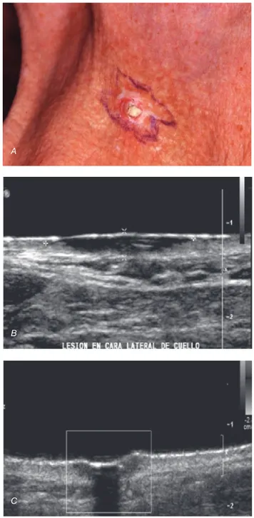 Cuadro 2. Comparación entre el grosor del melanoma con ultraso-