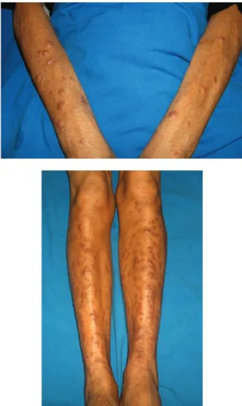 Figura  4.  Detalle  de  las  neoformaciones  de  aspecto  papular  y  nodular en la pierna.